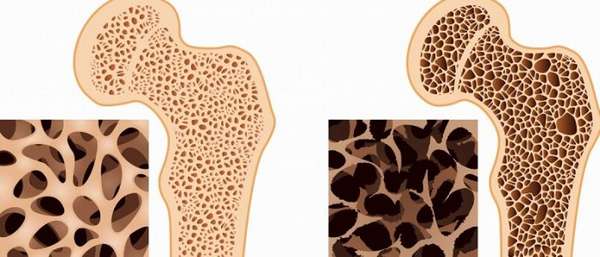 Причины и лечение пятнистого остеопороза